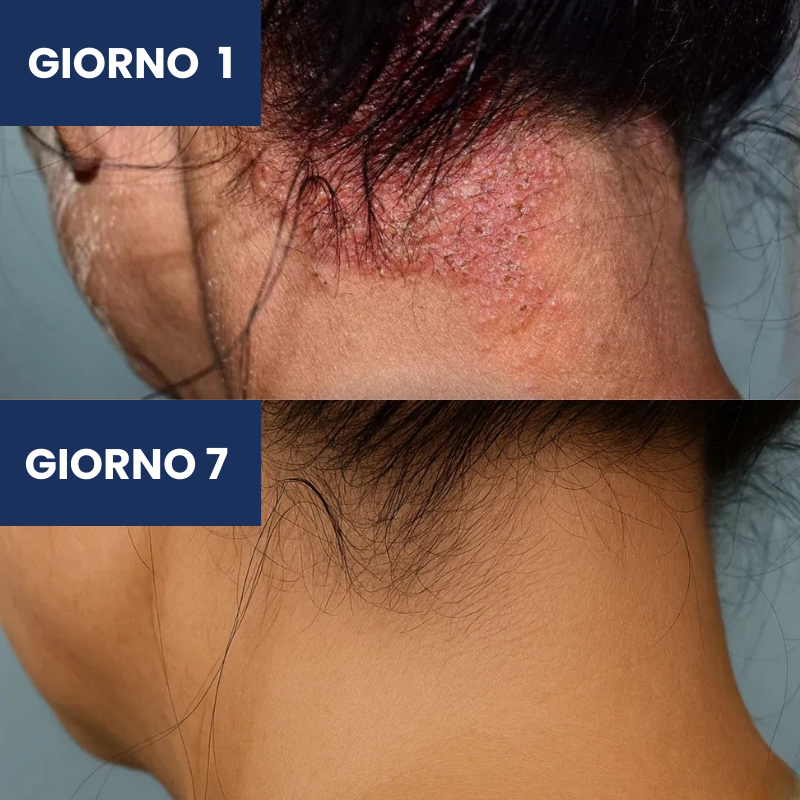 Eryno Psoriasis Cream