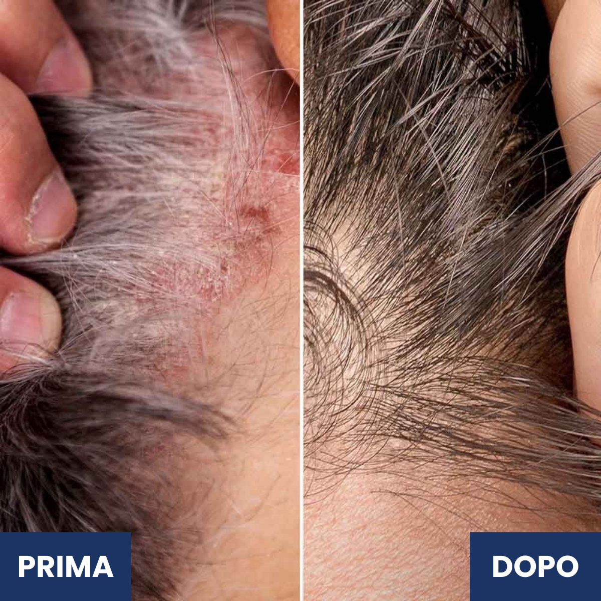 Eryno Psoriasis Cream